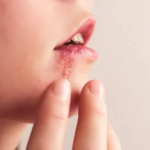 Consulta de Herpes