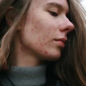 Consulta de Acne